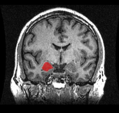 634px-MRI_Location_Amygdala_up
